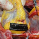 Dissection of stabbed woman