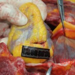 Dissection of stabbed woman