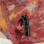 Dissection of stabbed woman