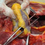 Dissection of stabbed woman