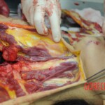 Dissection of stabbed woman