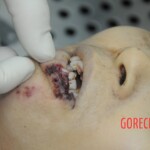 Dissection of stabbed woman