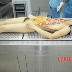 Dissection of stabbed woman