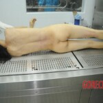 Dissection of stabbed woman