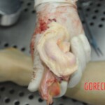 Dissection of stabbed woman