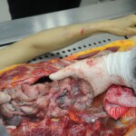 Dissection of stabbed woman
