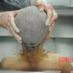 Dissection of stabbed woman