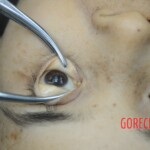 Dissection of stabbed woman