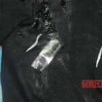 Dissection of stabbed woman