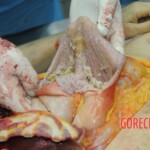 Dissection of stabbed woman