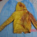 Dissection of stabbed woman