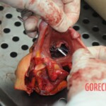 Dissection of stabbed woman