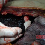 Dissection of stabbed woman