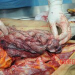 Dissection of stabbed woman