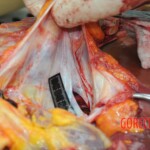 Dissection of stabbed woman