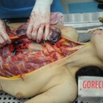 Dissection of stabbed woman