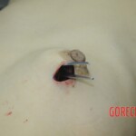 Dissection of stabbed woman