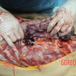 Dissection of stabbed woman