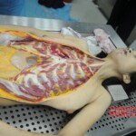 Dissection of stabbed woman