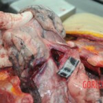 Dissection of stabbed woman