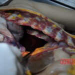 Dissection of stabbed woman