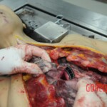 Dissection of stabbed woman