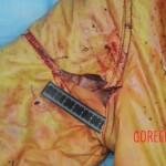 Dissection of stabbed woman