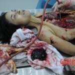 Dissection of stabbed woman