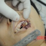 Dissection of stabbed woman