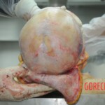 Dissection of stabbed woman