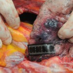 Dissection of stabbed woman