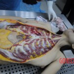 Dissection of stabbed woman