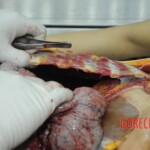 Dissection of stabbed woman
