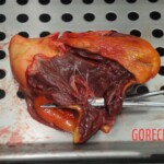 Dissection of stabbed woman