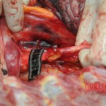 Dissection of stabbed woman