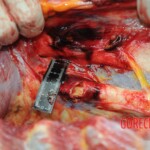 Dissection of stabbed woman