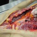 Dissection of stabbed woman