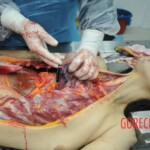 Dissection of stabbed woman