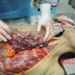 Dissection of stabbed woman