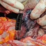 Dissection of stabbed woman