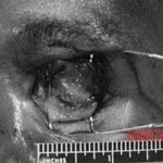 Eyeball killer victim