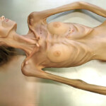 Autopsy of extreme anorexic woman