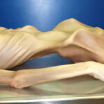 Autopsy of extreme anorexic woman