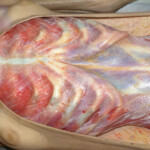 Autopsy of extreme anorexic woman