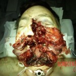 Facial reconstruction after accident