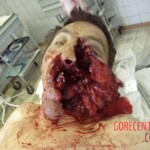 Facial reconstruction after accident