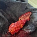 Woman cutting fat off from her belly