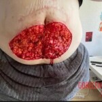 Woman cutting fat off from her belly