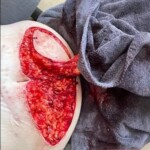 Woman cutting fat off from her belly