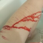 Self harm